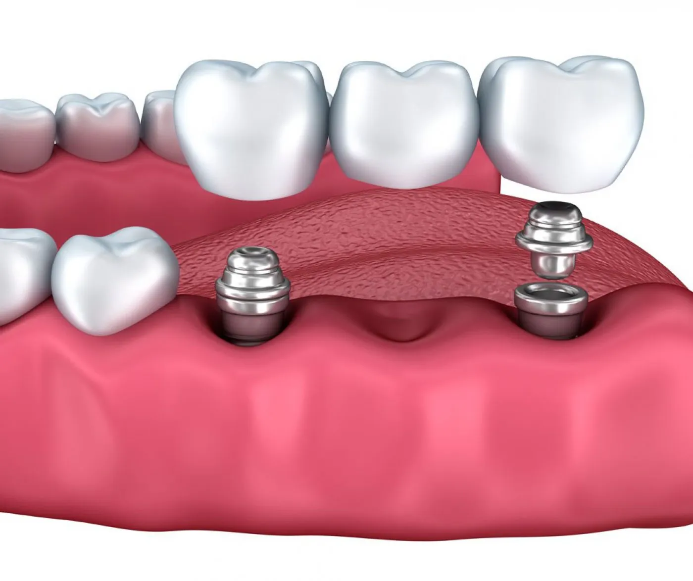 Aston Clinton Dental Implants Multiple