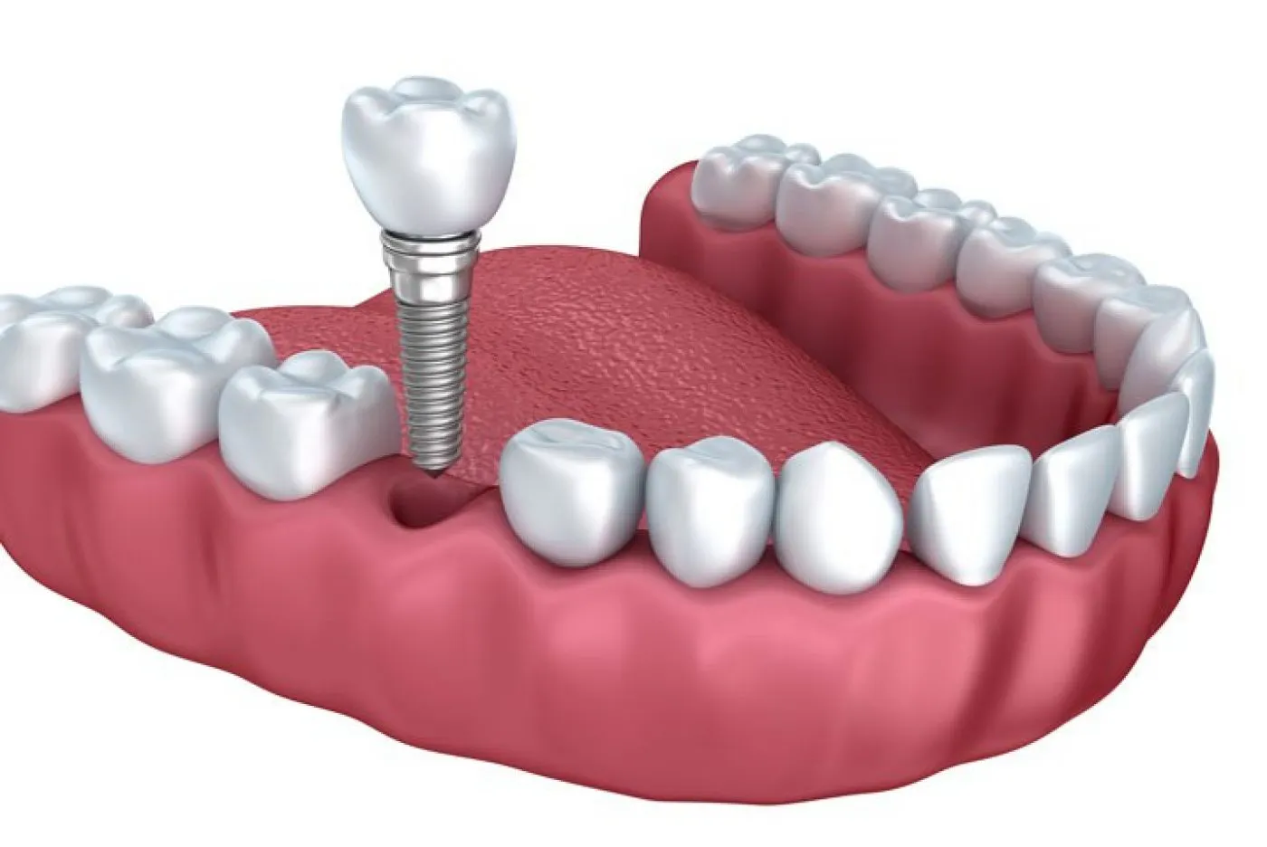 Aston Clinton Dental Implants Single