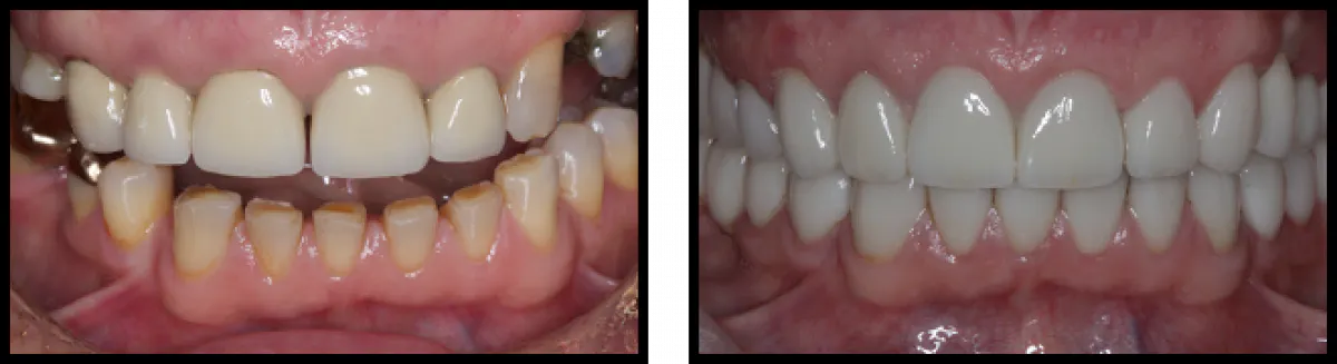 Case 2 Crowns Full Mouth
