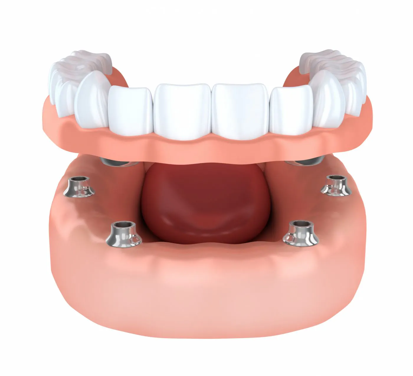 Dental Implant Elms Lea 1