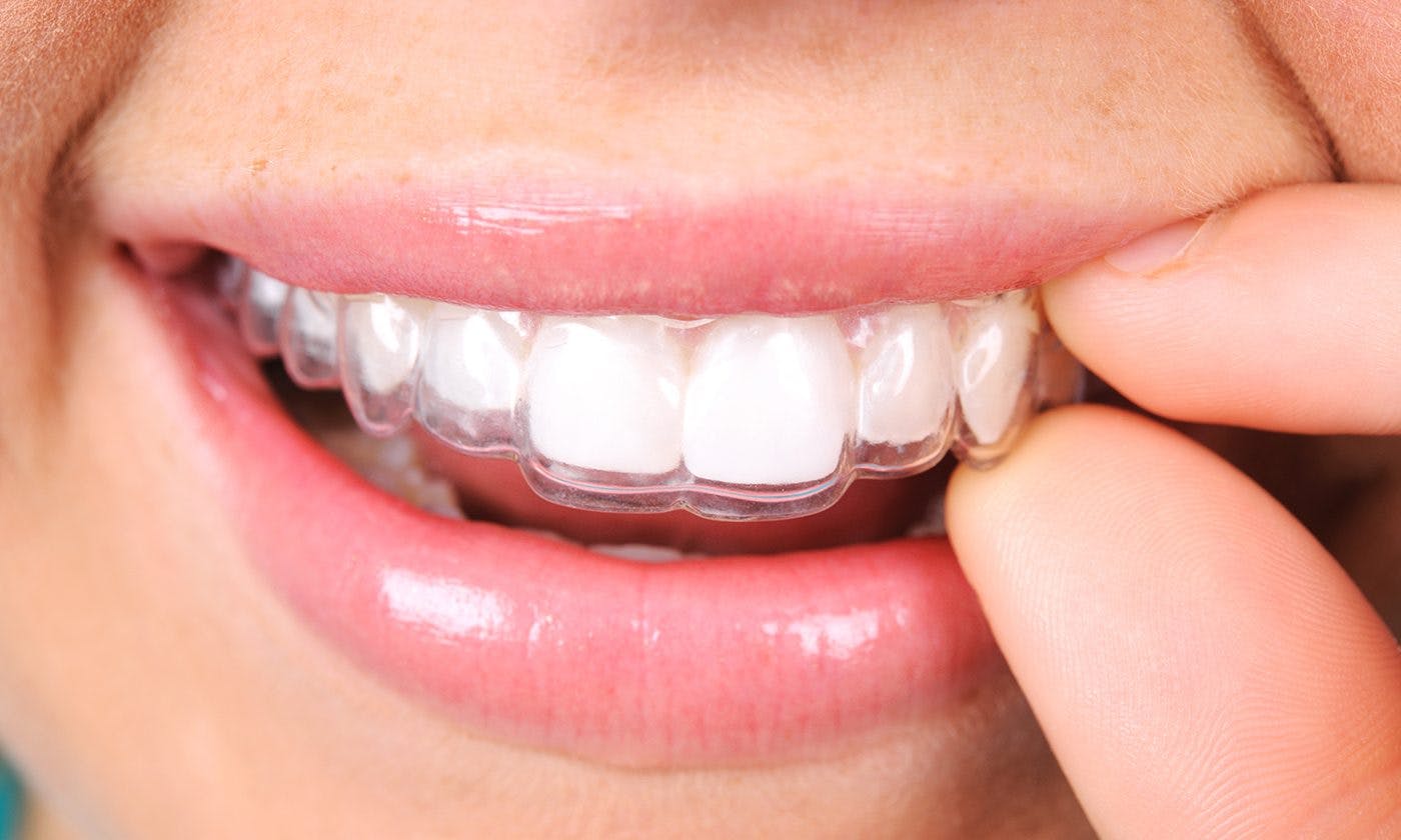Hayes Dental Specialists Clear Braces
