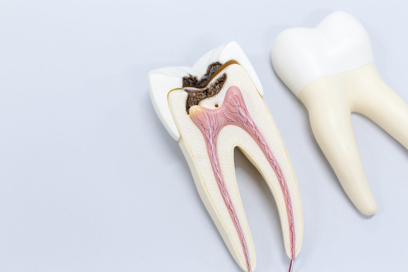 Hayes Dental Specialists Root Canal