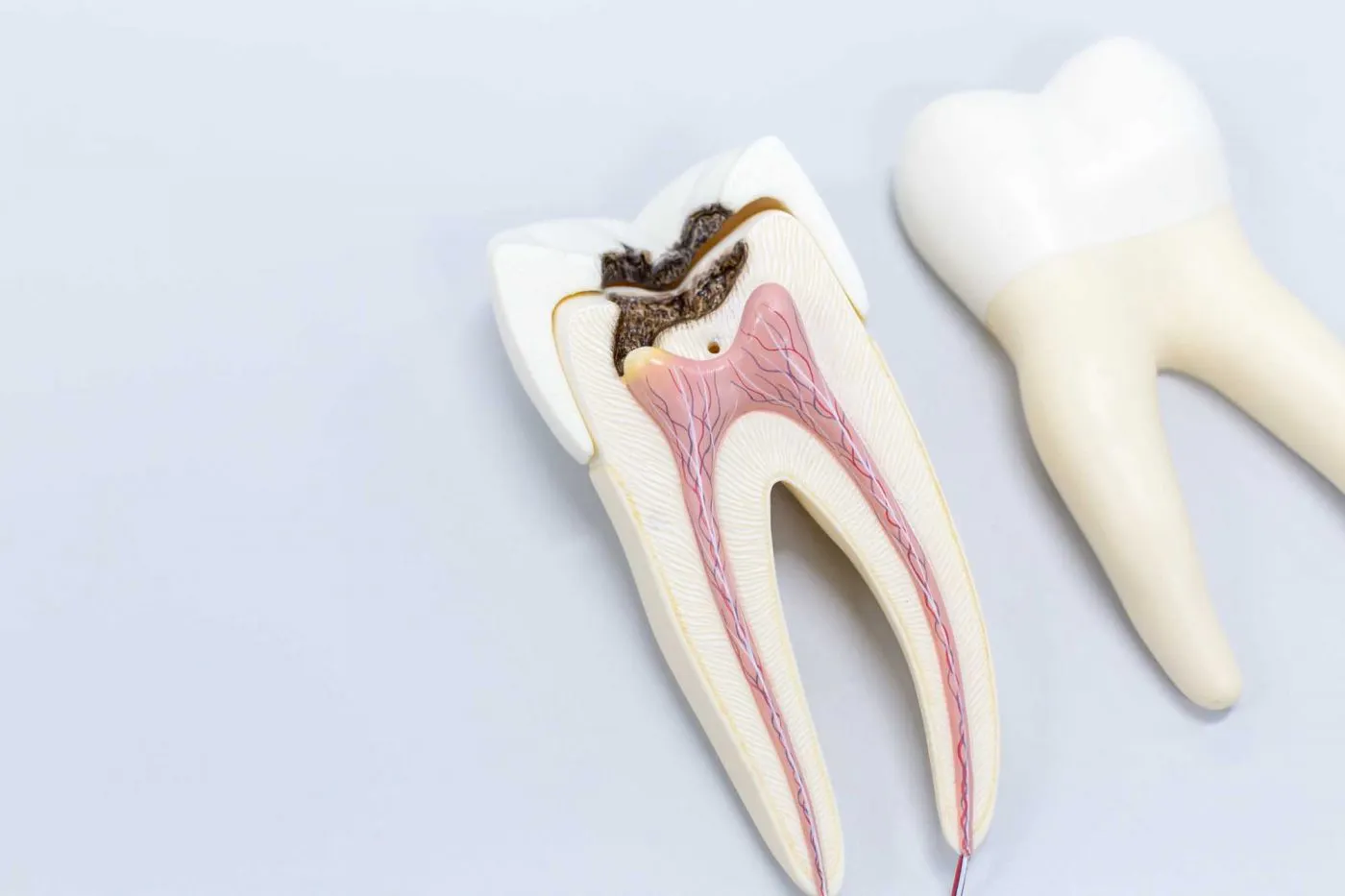 Root Canal Tooth Treatment