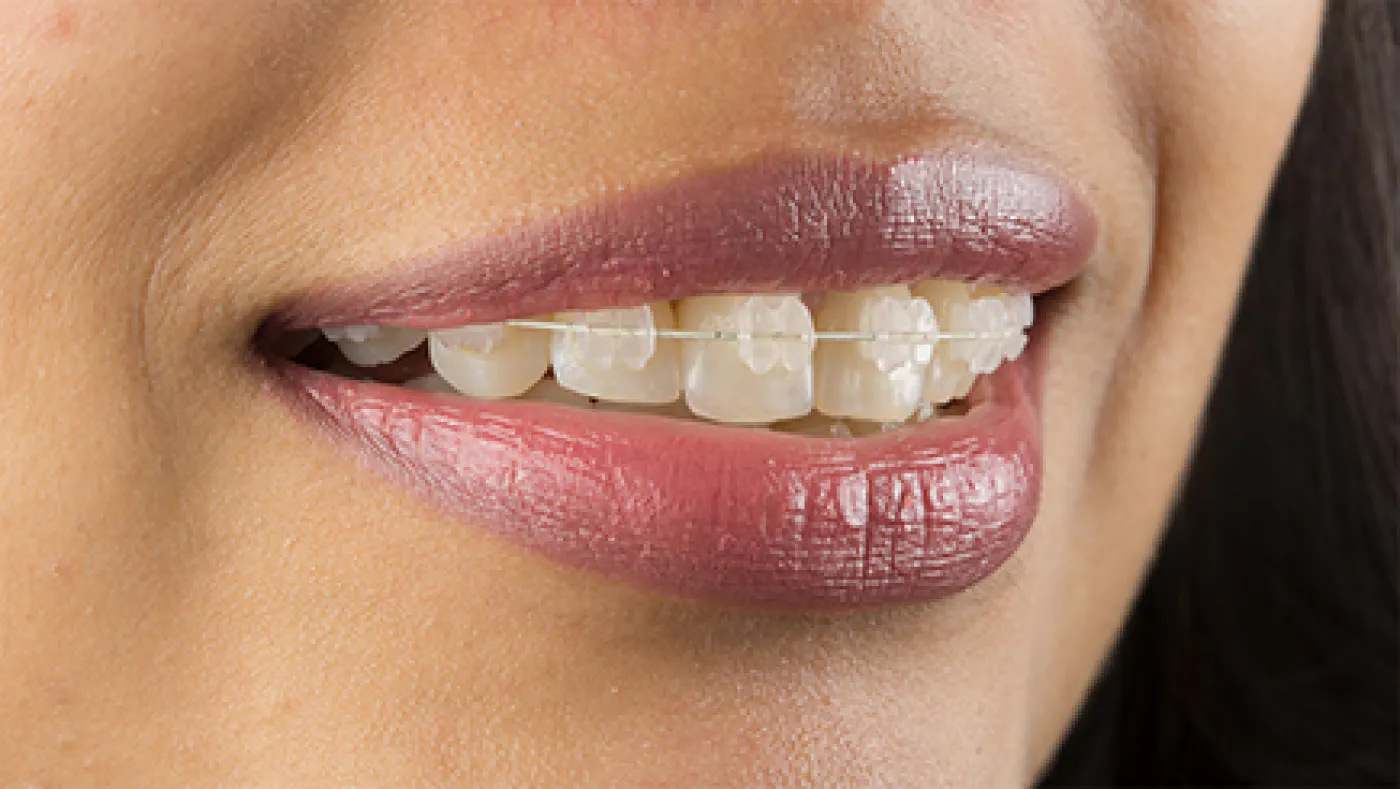 Whitby Dental Quickstraightteeth