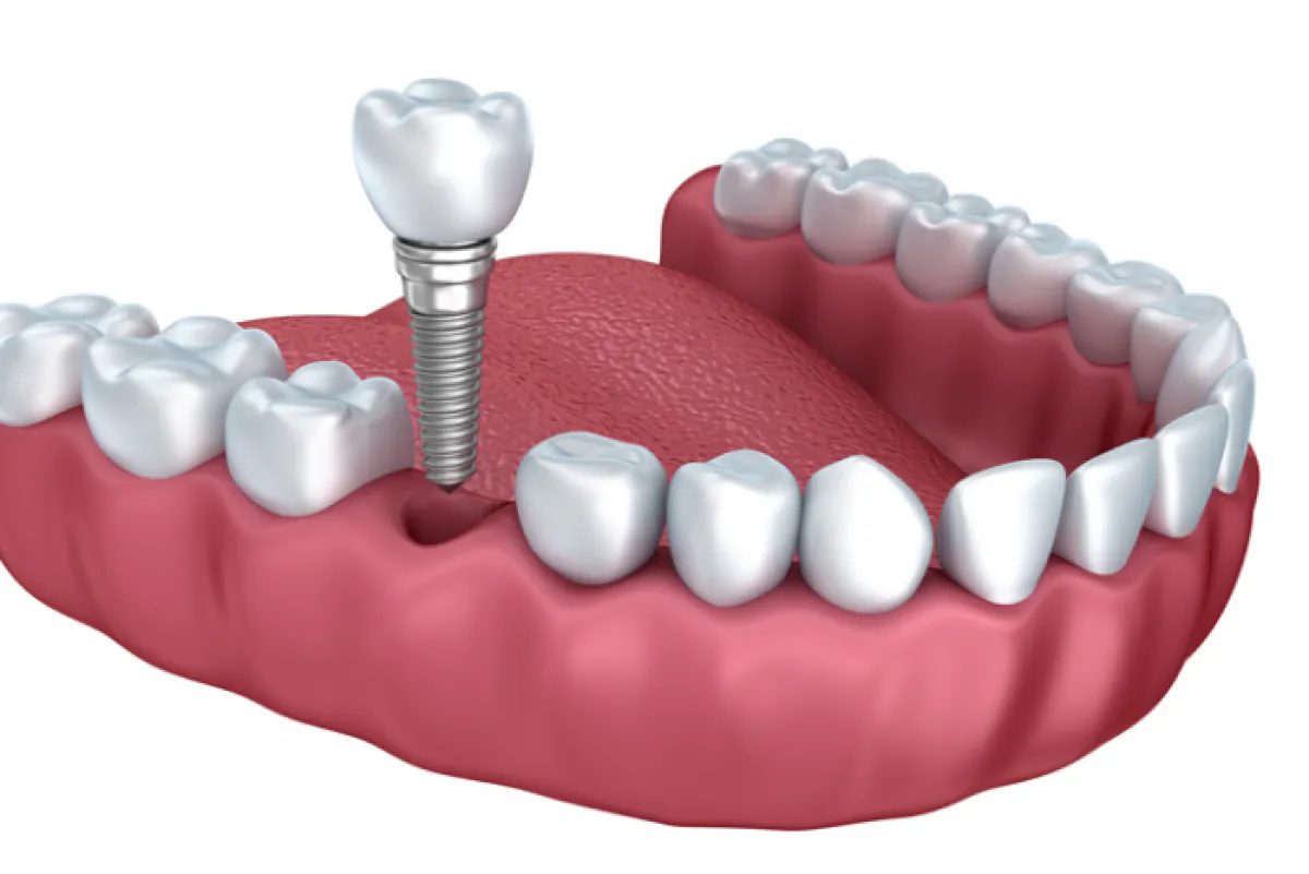 Portman Dental Implant Clinic Single Implant