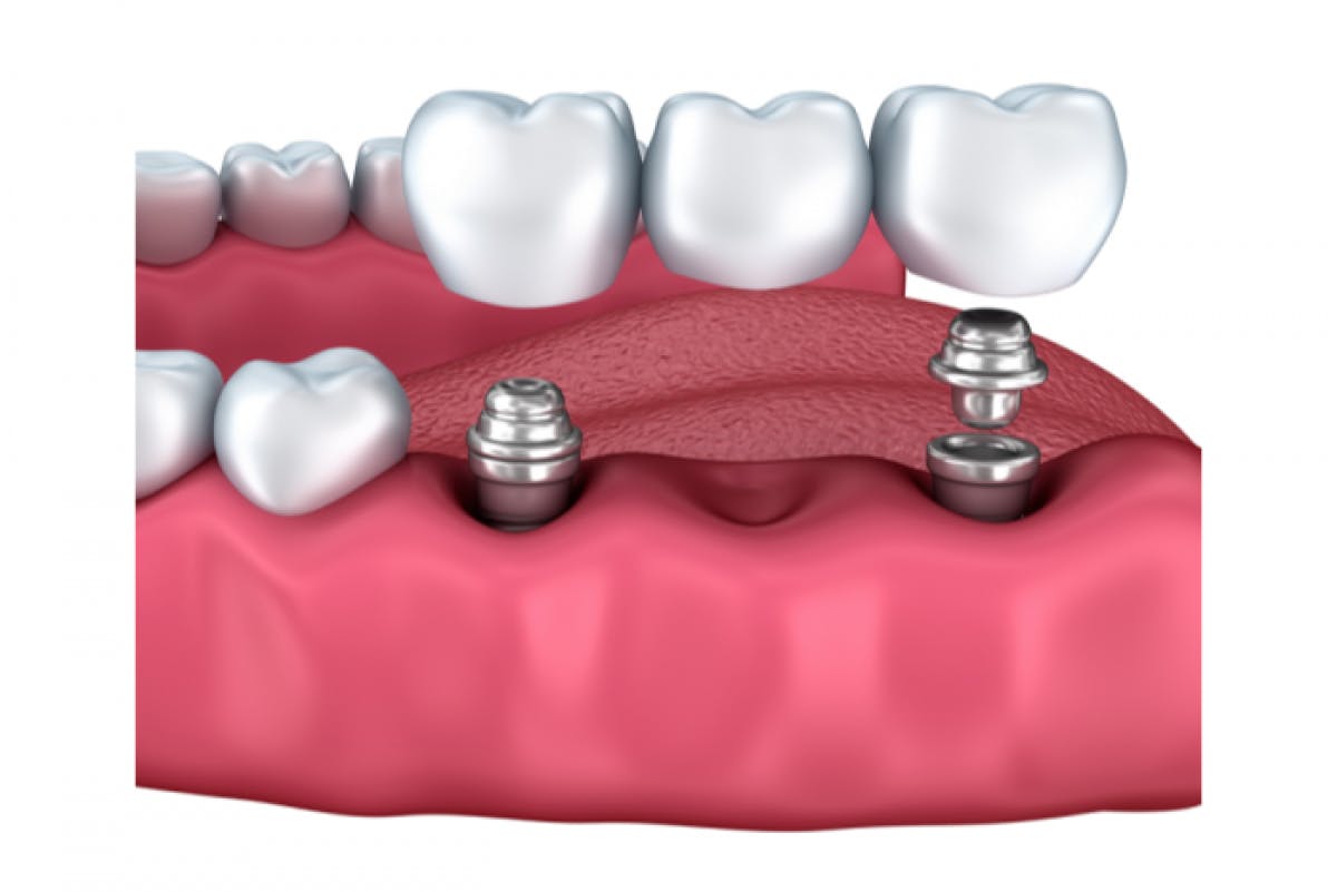 Dental Implants in Fakenham Brooklyn House & Implant Clinic