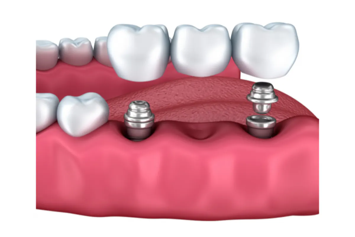 Portman Dental Implant Clinic Multiple Implant