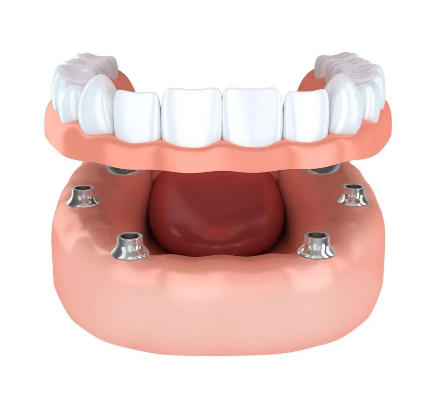 Dental Implants Sameday Courtrai House Dental Implant Clinic