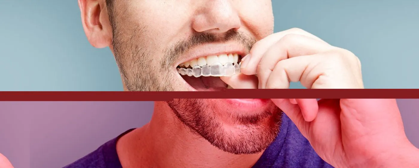 Hdic Orthodontics Invisalign