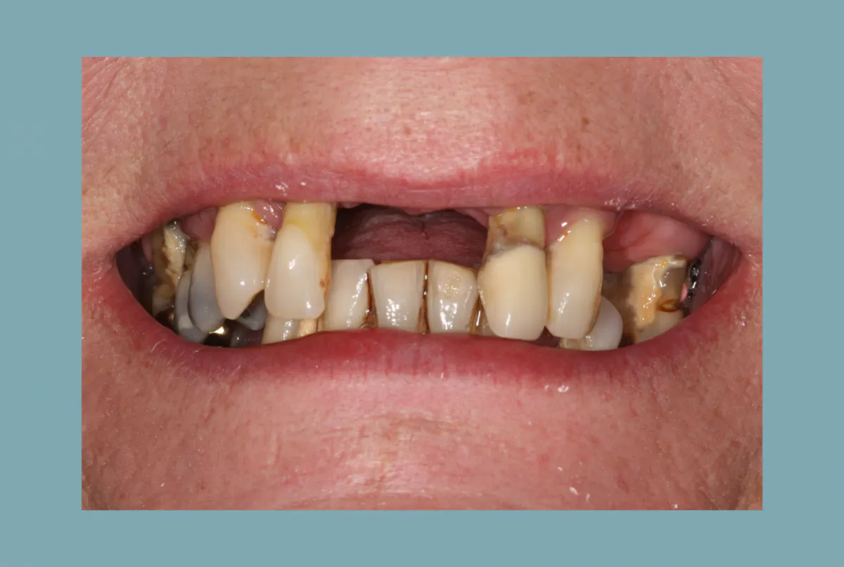 Mc Grath Implant Secured Dentures Before 1