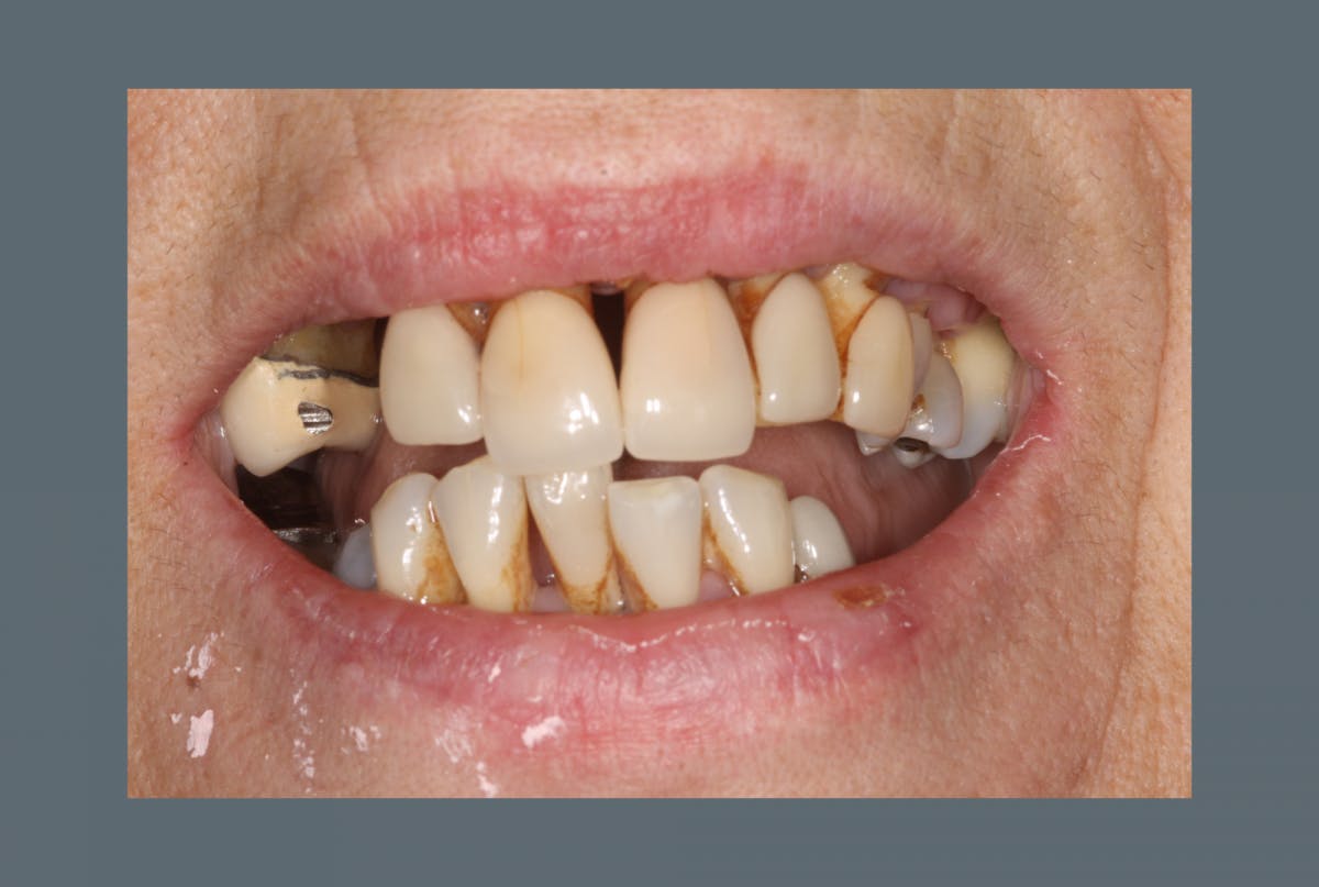 Mc Grath Implant Secured Dentures Before 2