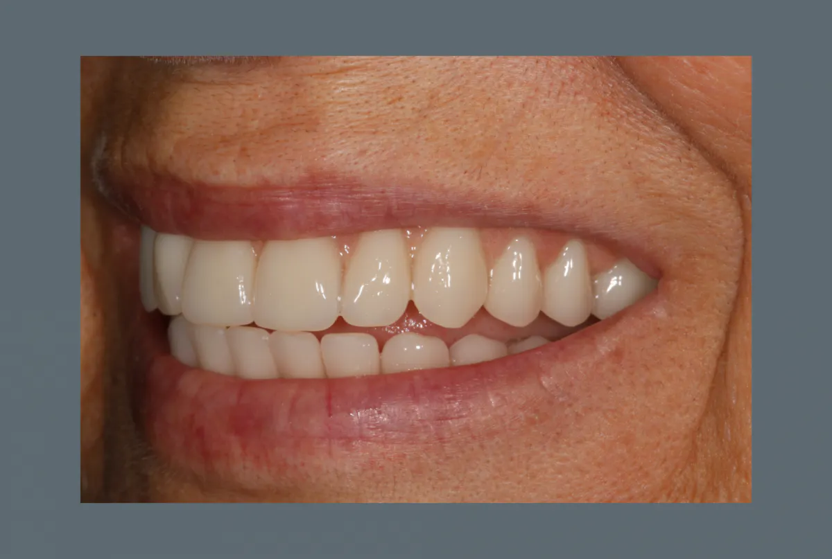 Mc Grath Implant Secured Dentures Side After 2