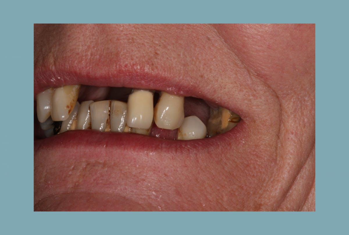 Mc Grath Implant Secured Dentures Side Before 1