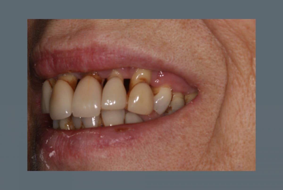 Mc Grath Implant Secured Dentures Side Before 2