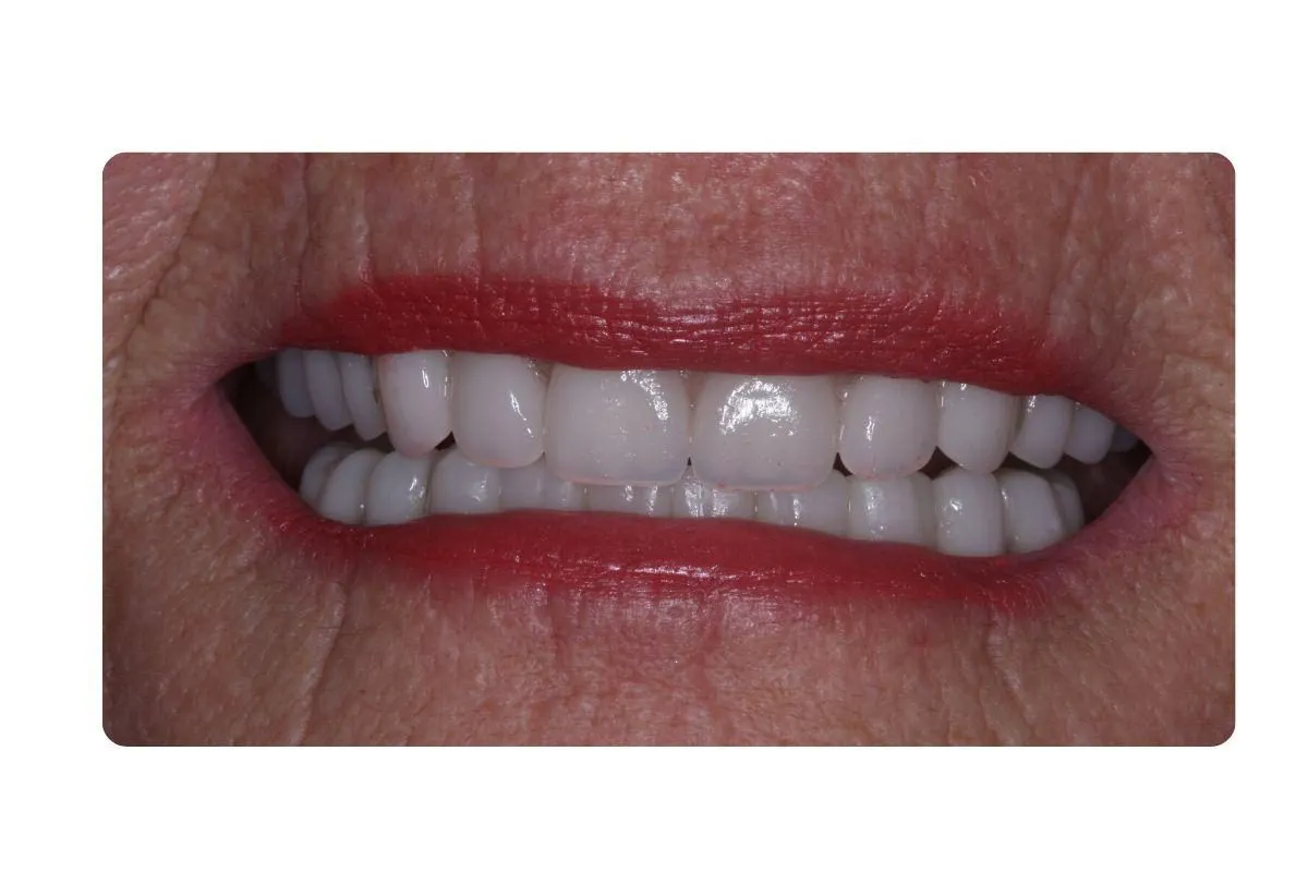 Implant Secured Dentures 2