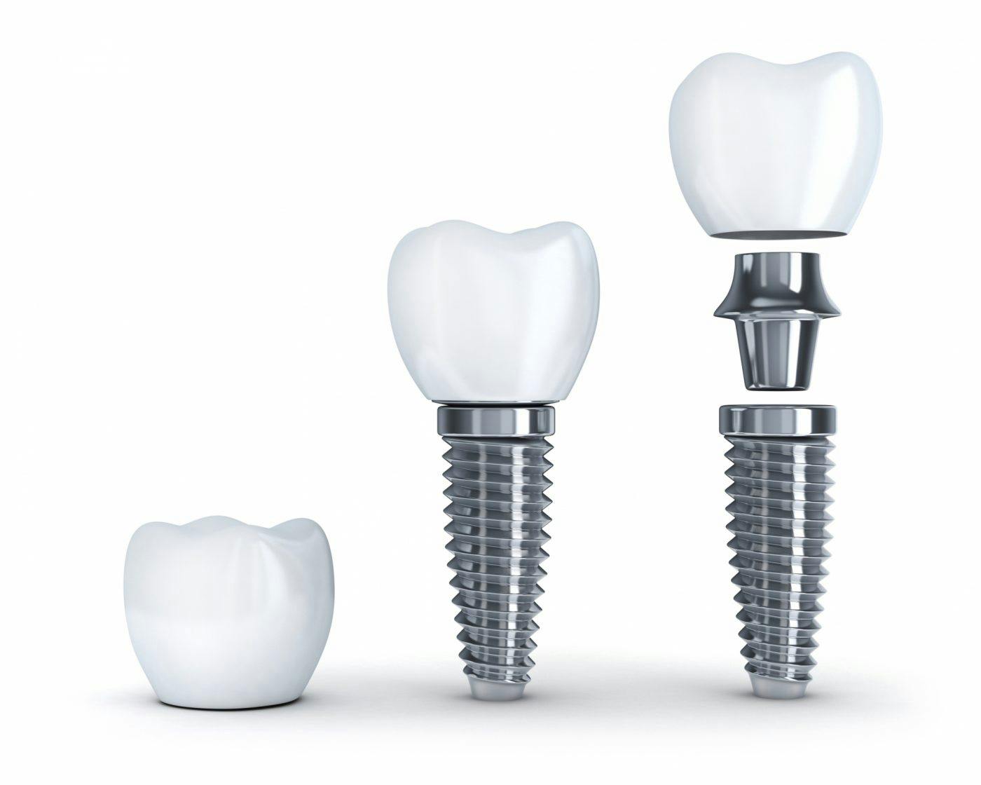 Granville Dental Implants 1