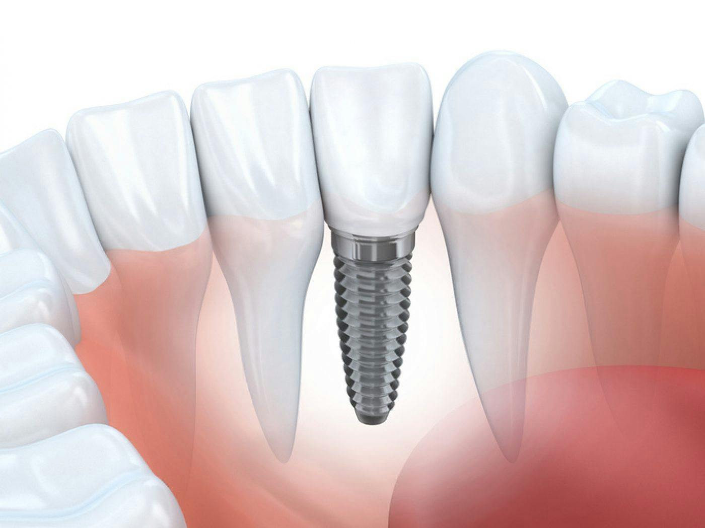 Single Implant Portman Dental And Implant Clinic Maidenhead