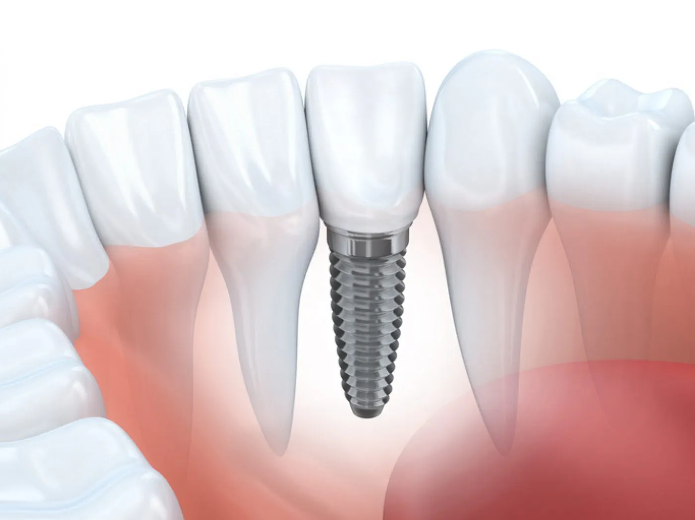 Single Implant Portman Dental And Implant Clinic Maidenhead