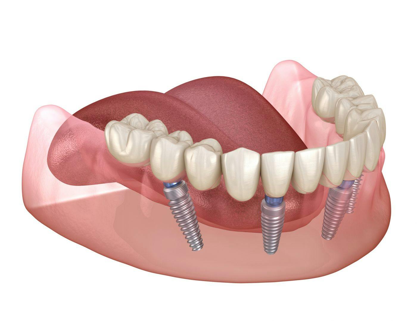 Dental Implants Solutions Missing Teeth 2