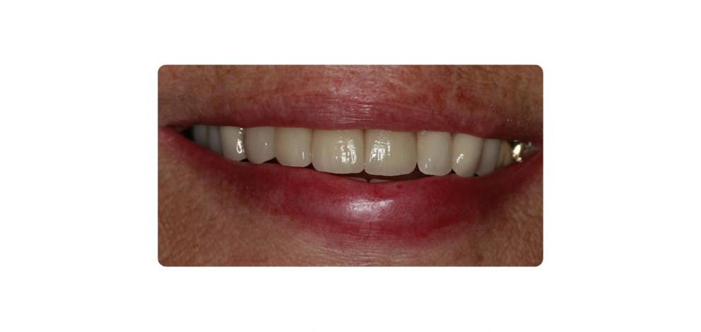 Dental Implant Wadebridge A1