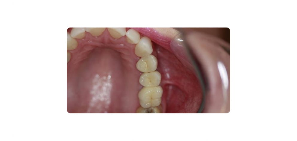 Dental Implant Wadebridge A2