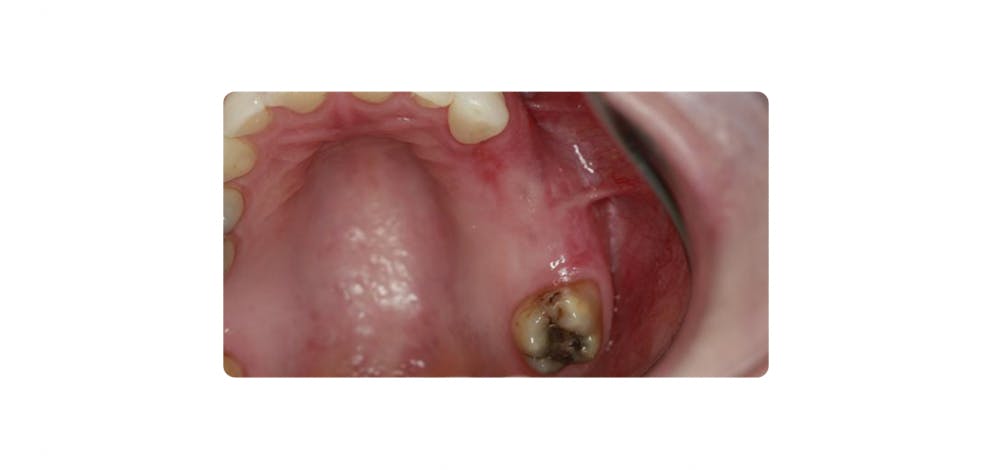 Dental Implant Wadebridge B2
