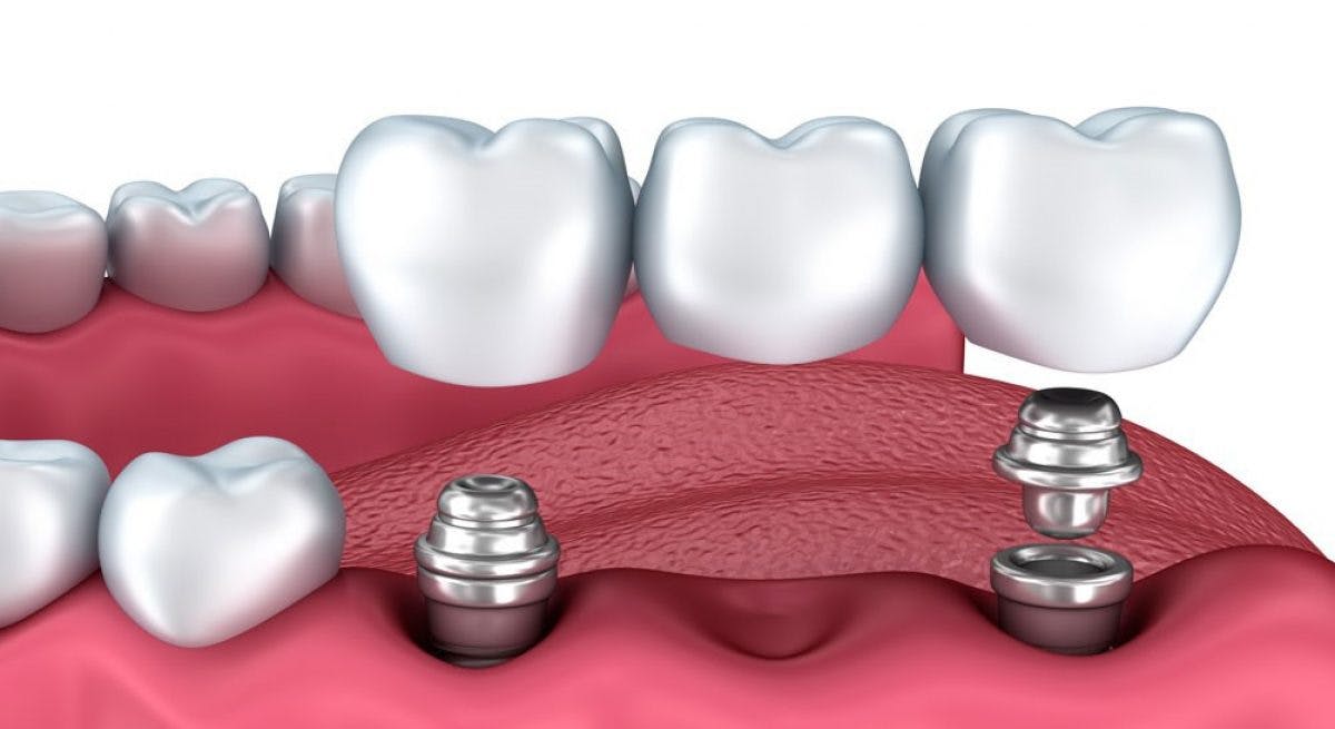 Dental Implants Multiple Pic