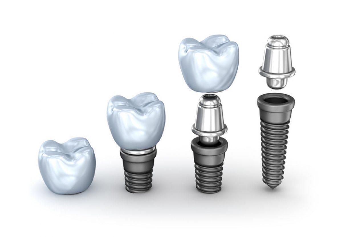 Multiple Dental Implants in Sheffield Portman Dental & Implant Clinic