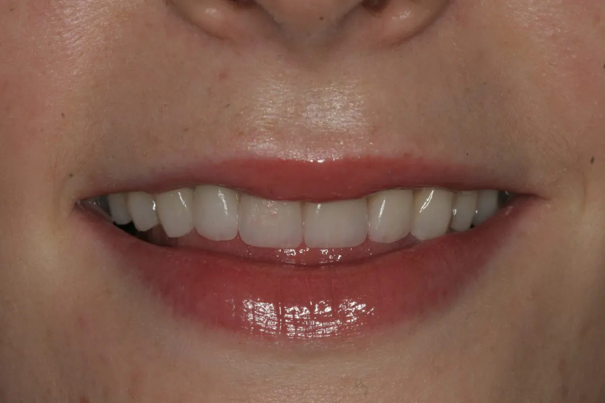Post Treatment Close Up Smile 114
