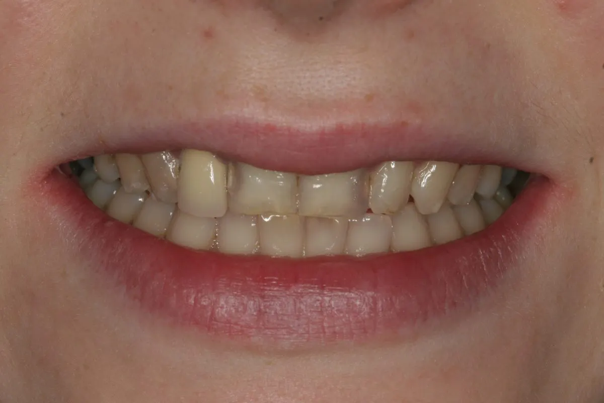 Pre Treatment Close Up Smile 028