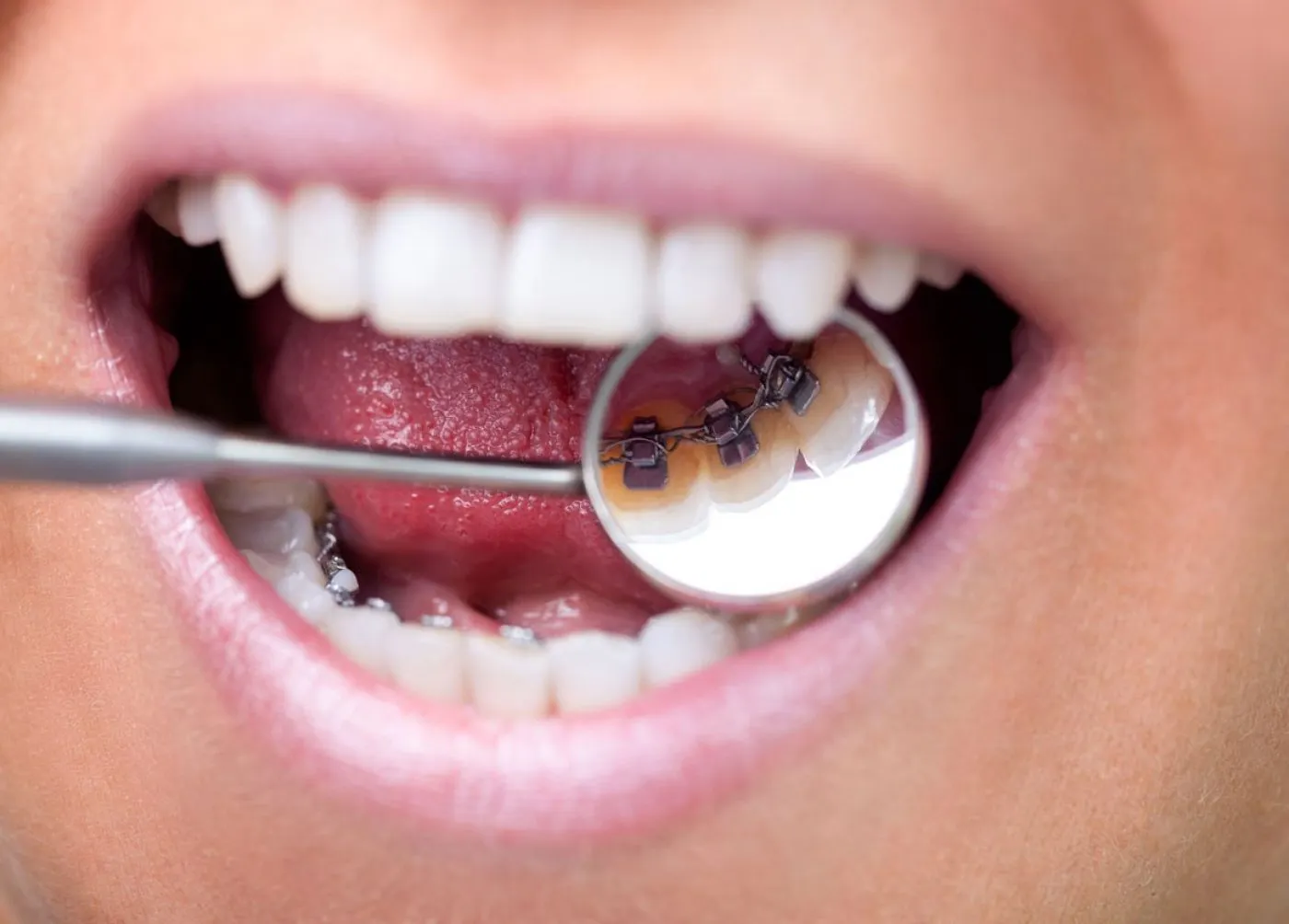 Orthodontics Hidden Braces Uppingham Dental Implant Clinic