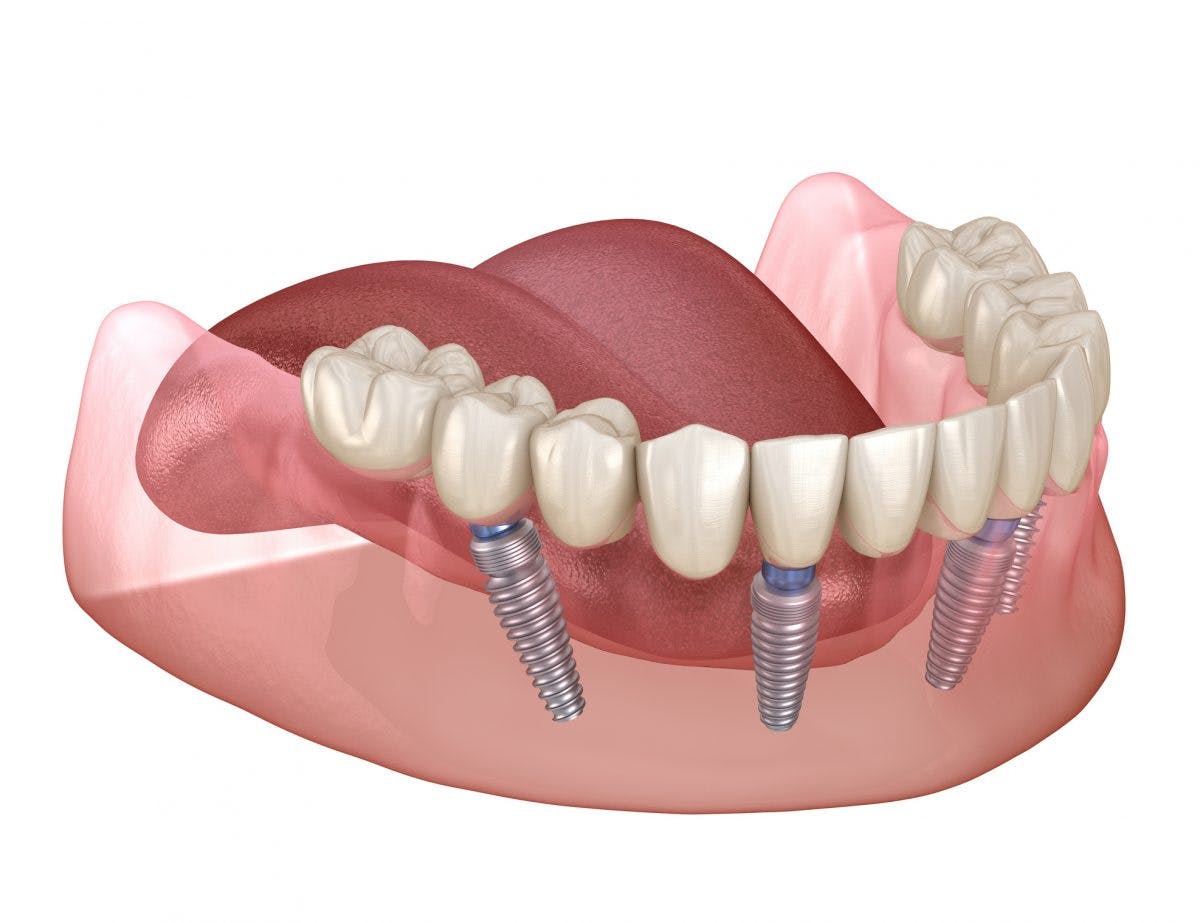 implant secured dentures