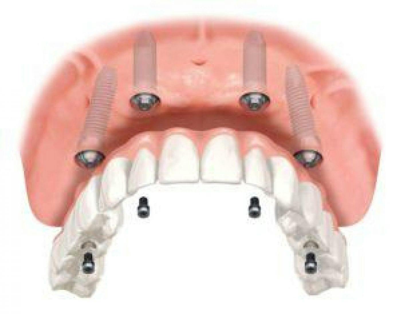 Full Arch Dental Implants 300X235