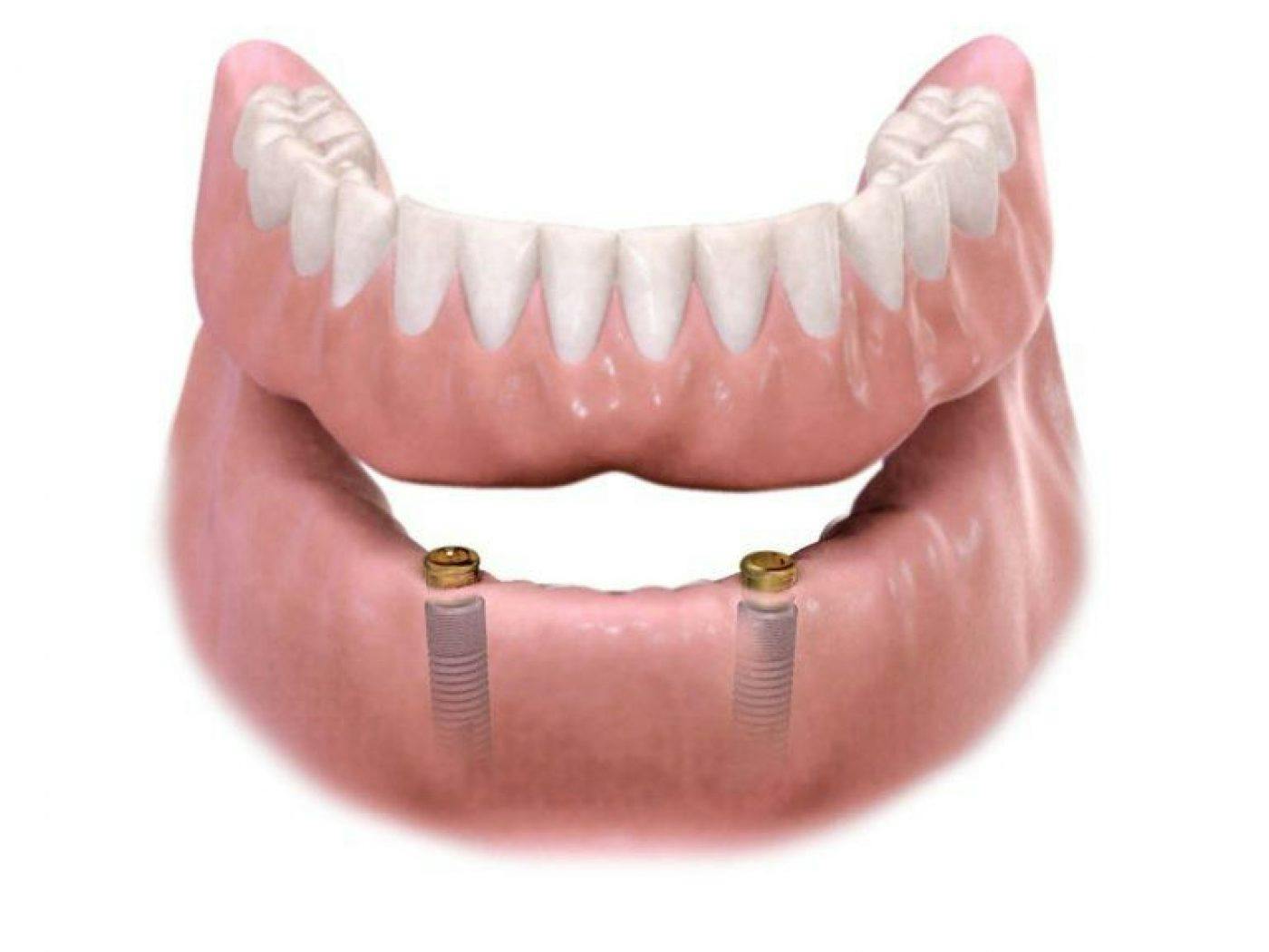 Implant Retained Denture 768X576
