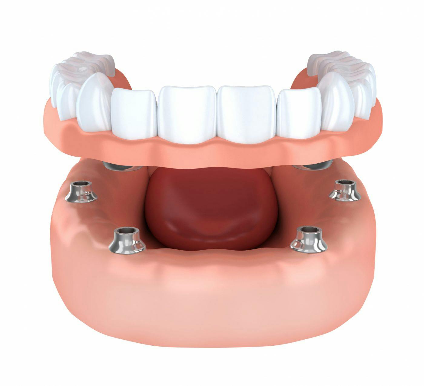Acomb Dental Implants 4