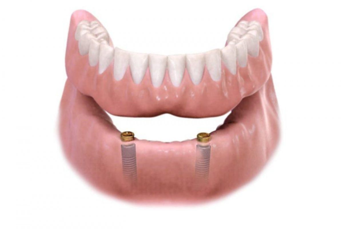 Portman Dental & Implant Clinic Launceston Implant Secured Dentures