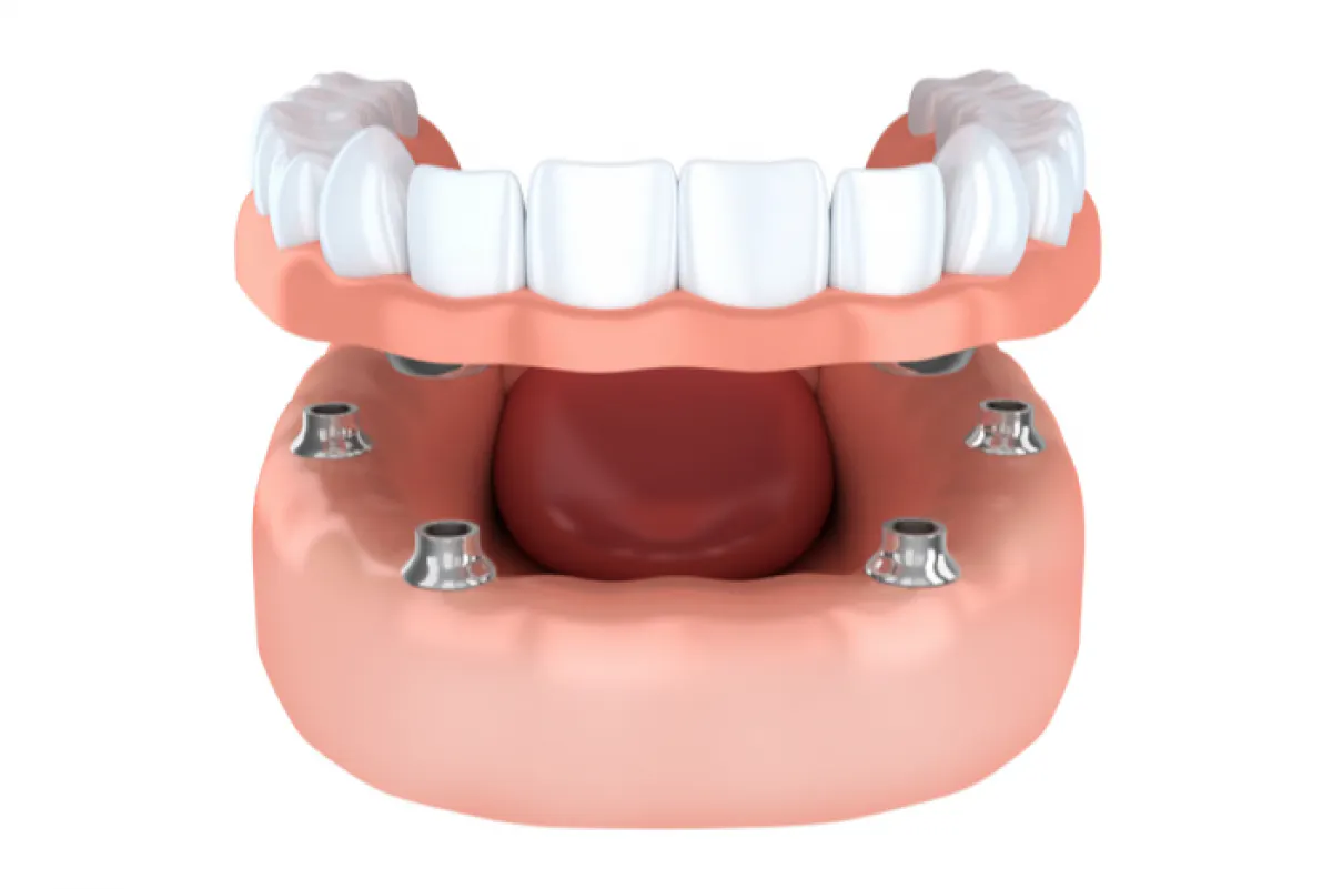 Portman Dental & Implant Clinic Launceston same Day Teeth