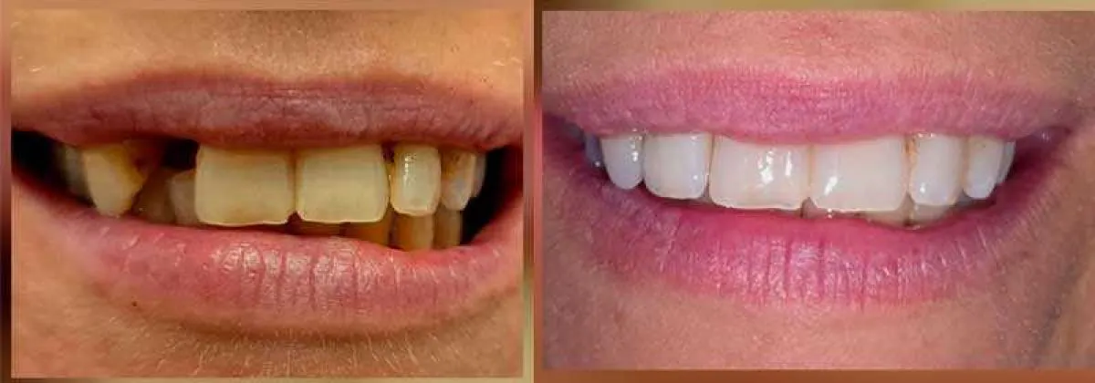 Before After Implants2 Hayes Web