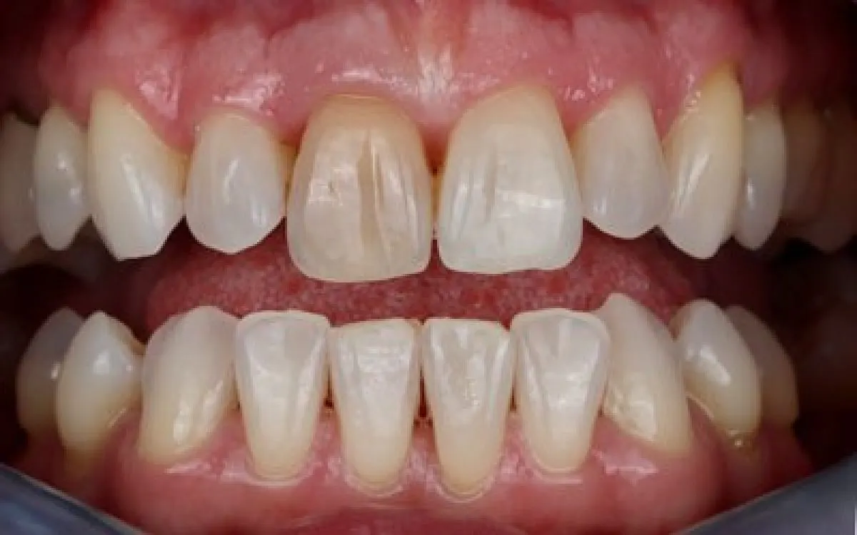 Composite Bonding 1 Before Web