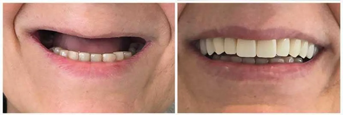Hayes All On 4 Teeth In A Day Web