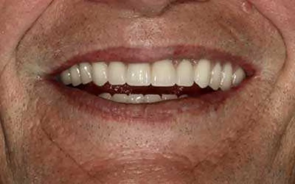 Implant Bridge 1 After Web