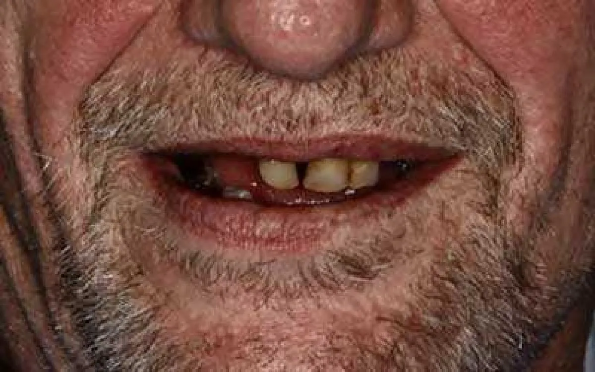 Implant Bridge 1 Before Web