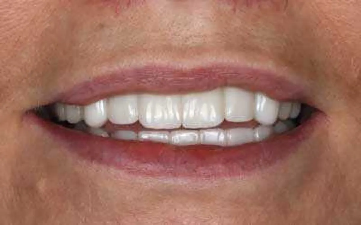 Implant Bridge 2 After Web