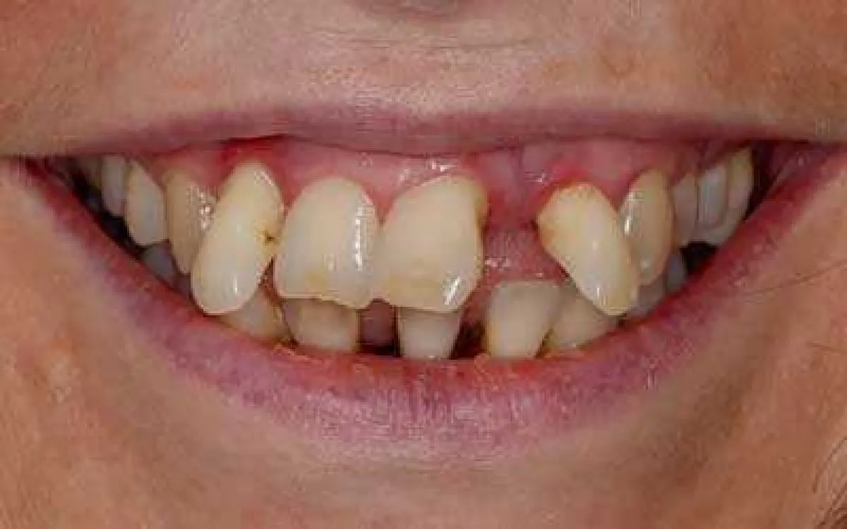 Implant Bridge 2 Before Web