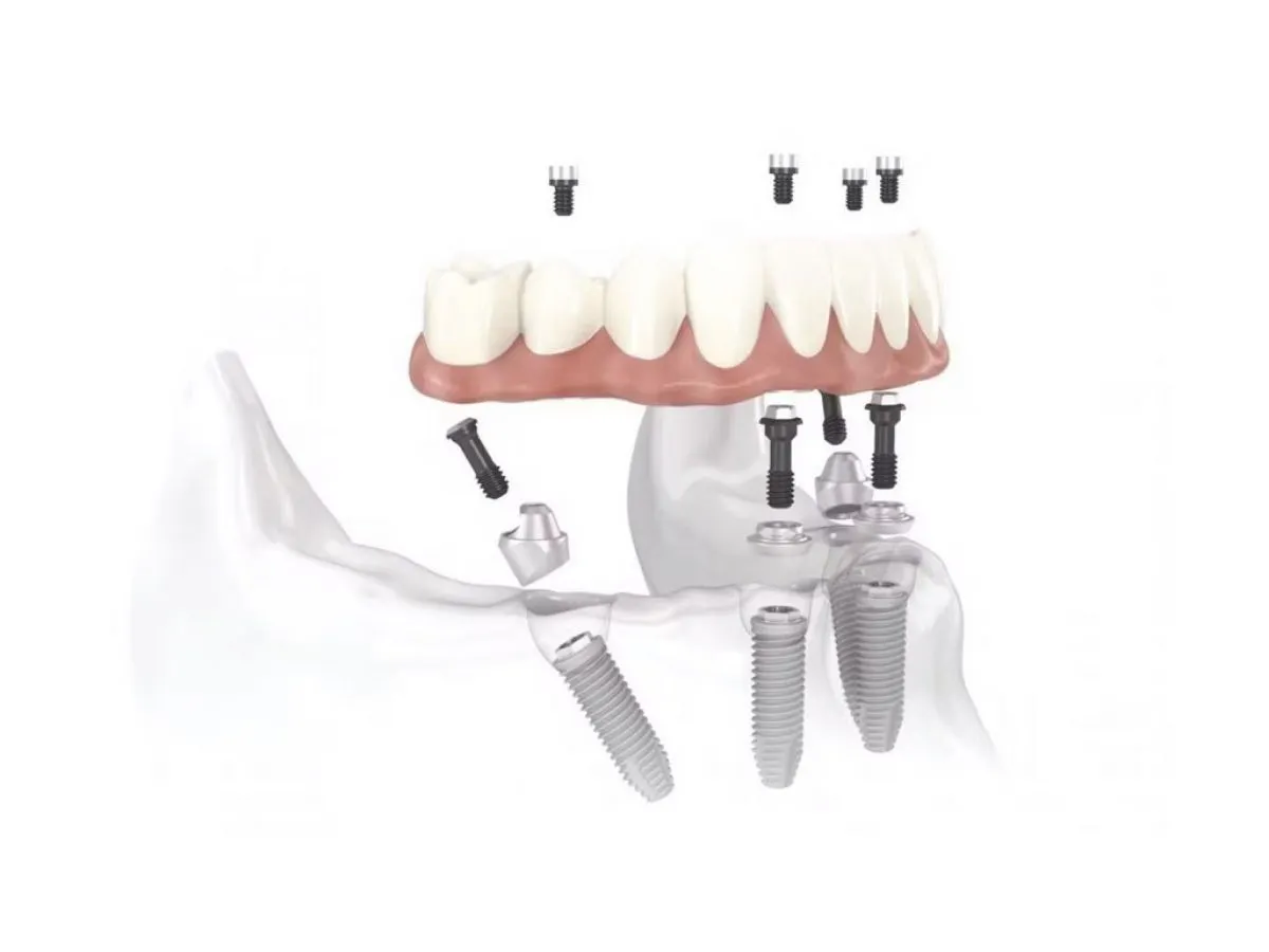 Ptda Full Dental Implants Warrington Model Wide Web