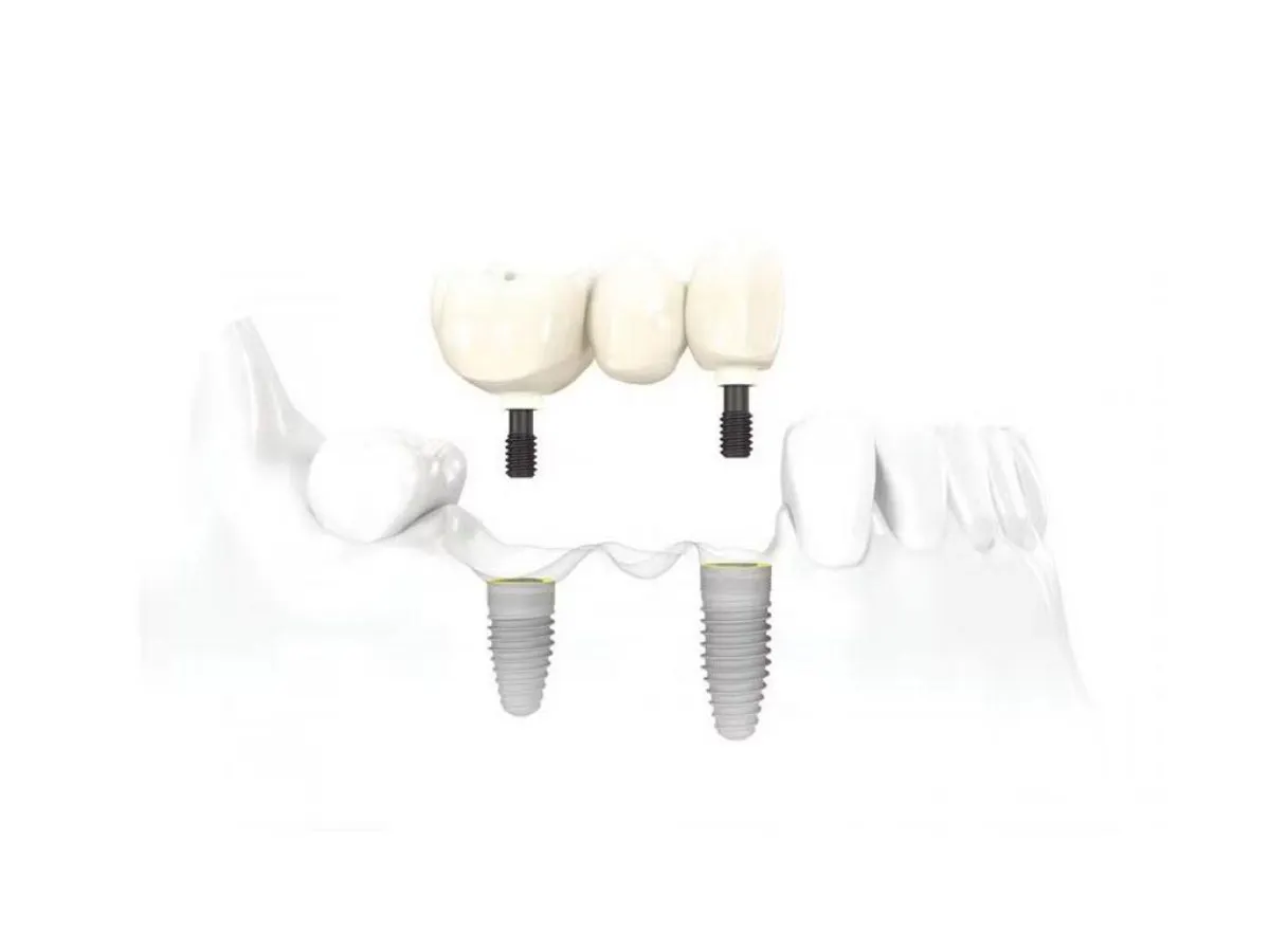 Ptda Multiple Dental Implants Warrington Model Wide Web