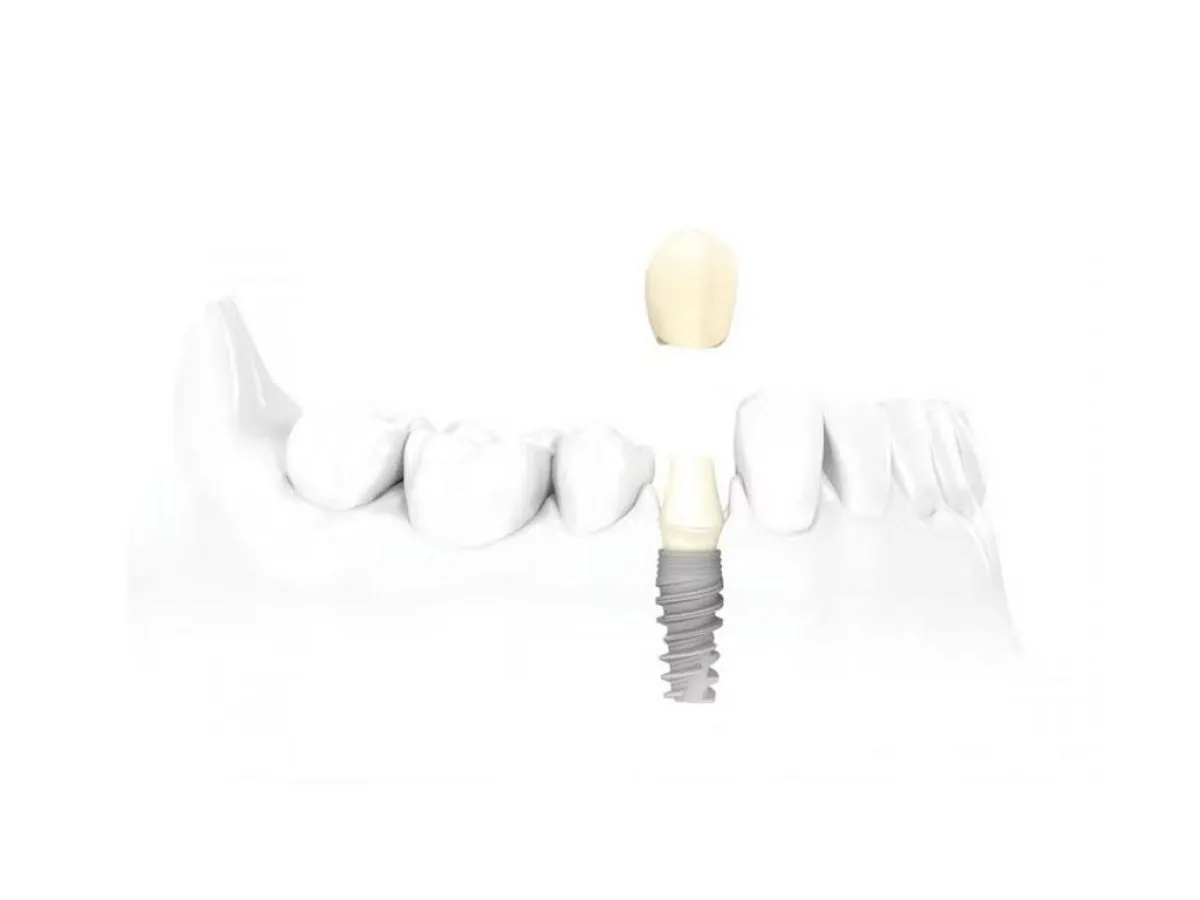 Ptda Single Dental Implant Warringto Model Wide Web