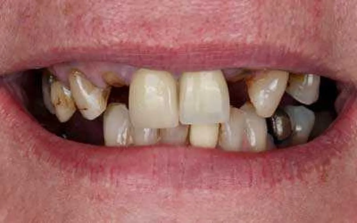Porcelain Bridge 1 Before Web