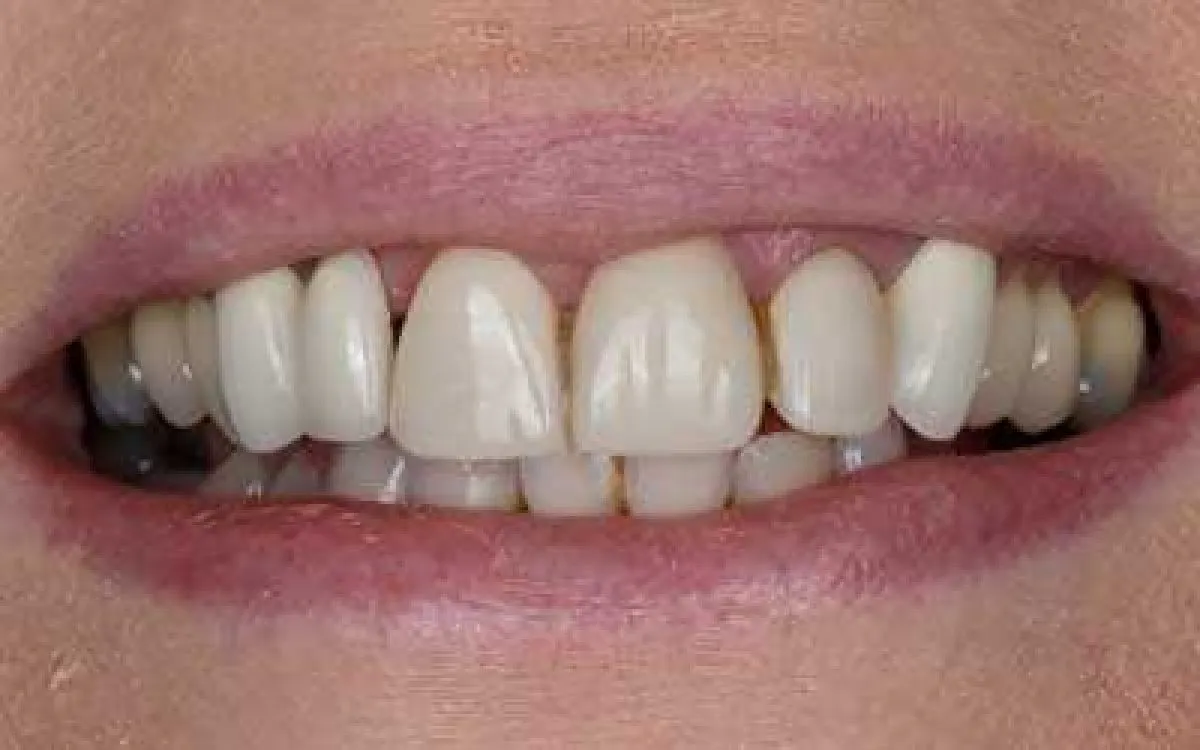 Porcelain Bridge 3 Before Web