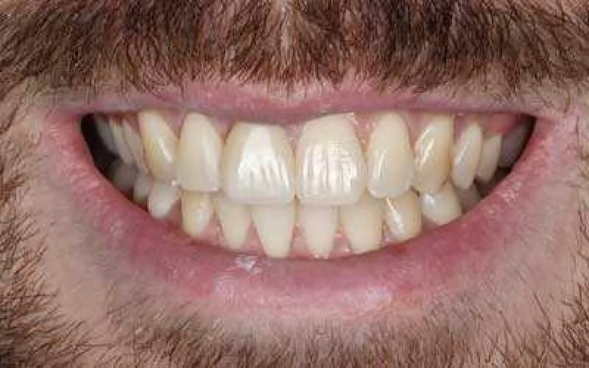 Root Canal And Porcelain Crown 1 After Web
